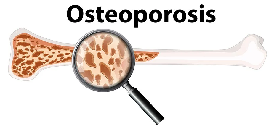 grafički prikaz osteporoze