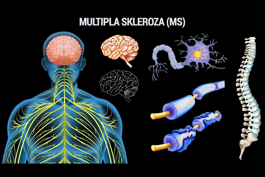 Multipla skleroza (MS)