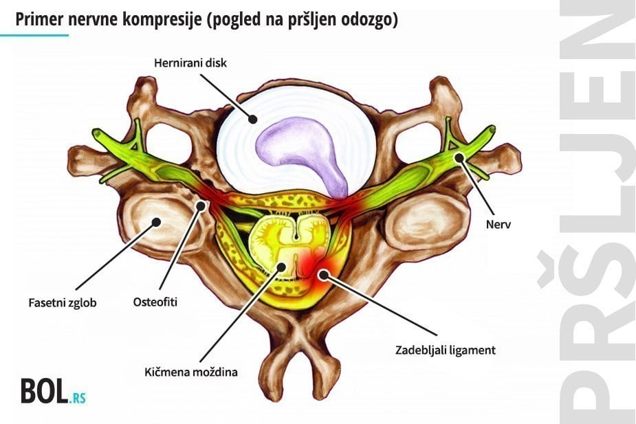Primer nervne kompresije