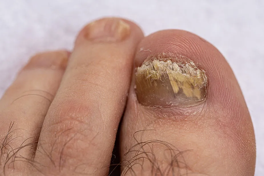 Gljivice na noktima nogu: Kako ih pobediti?