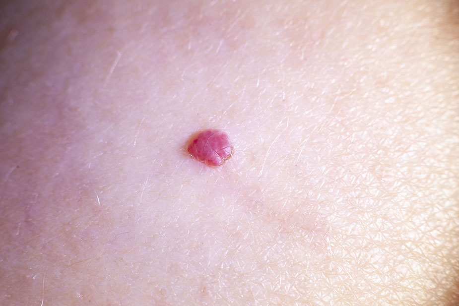 Izgled hemangioma