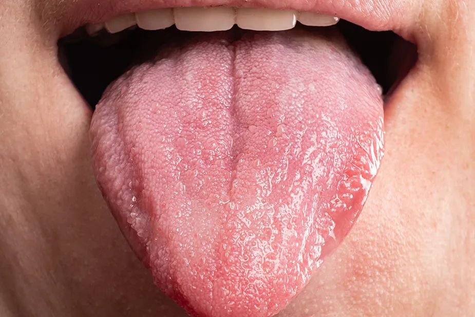 Bol u korenu jezika: 6 najčešćih razloga i kako ih rešiti