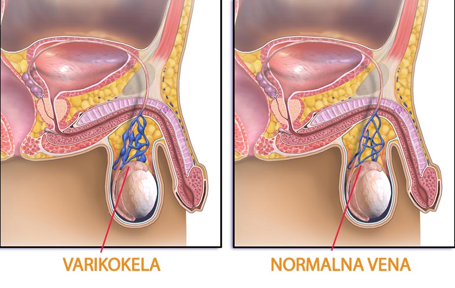Varikokela - ilustracija