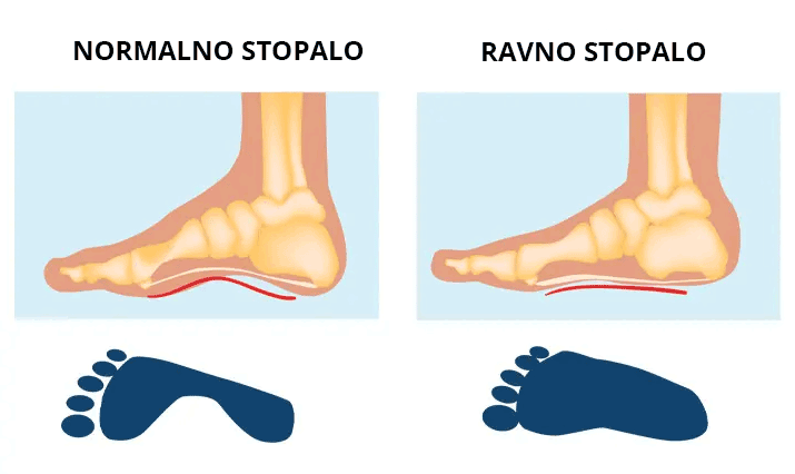 Ilustracija poređenja normalnog i ravnog stopala sa prikazom otisaka stopala.