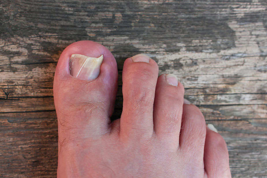 Deformisani žuti nokat na palcu noge na drvenoj podlozi.