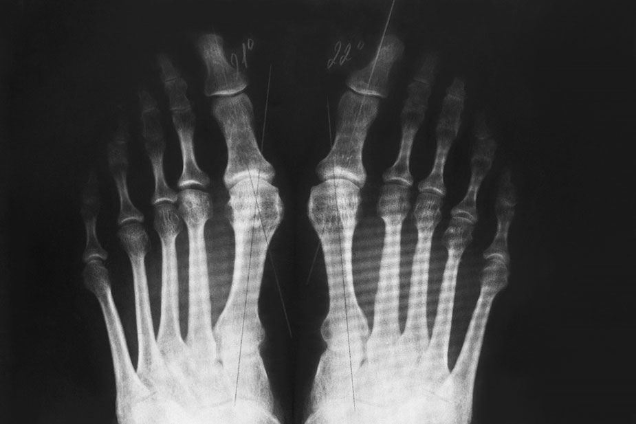 endgenski snimak stopala sa jasno vidljivim deformitetima poznatim kao čukljevi (hallux valgus) Rendgenski snimak stopala na kojima se vide deformiteti