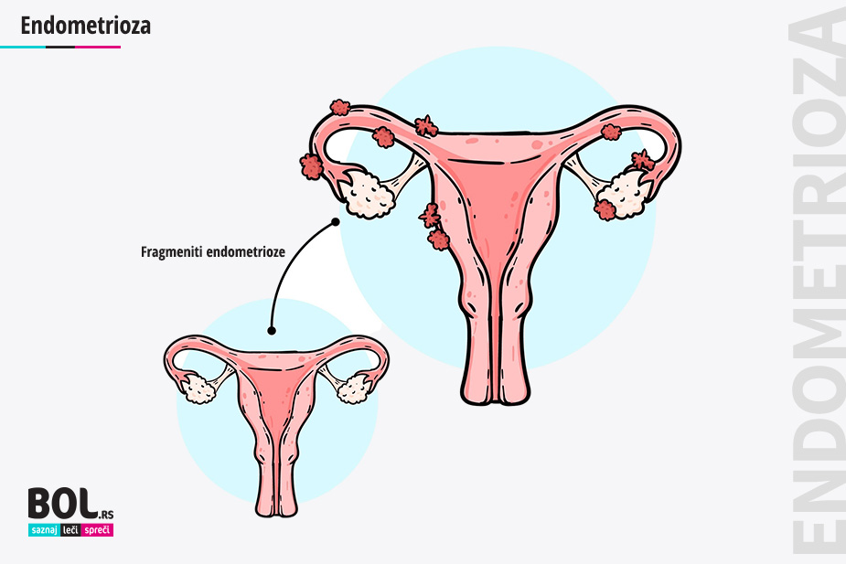 Ilustracija endometrioze