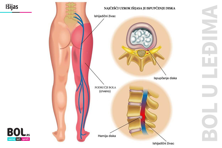 Ilustracija kako nastaje išijas