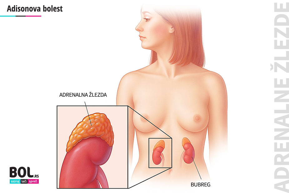 Anatomska ilustracija žene sa prikazom položaja nadbubrežnih (adrenalnih) žlezda iznad bubrega – objašnjenje funkcije adrenalnih žlezda kod Adisonove bolesti.